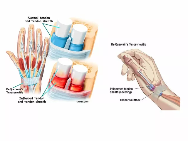 The Connection Between Ciprofloxacin and Tendon Damage