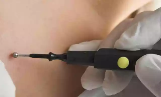 Can Warts Be Cured Completely? The Truth About Recurrence