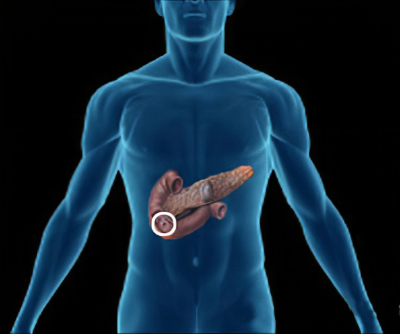 The Link Between Zollinger-Ellison Syndrome and Gastrointestinal Disorders